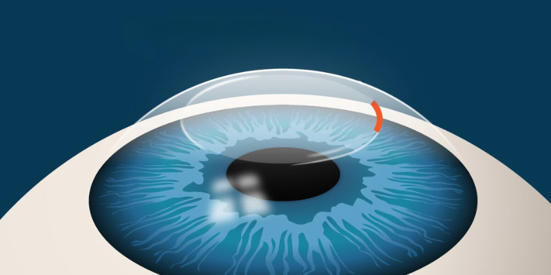 Corneal Surgery in Baramati - Prisma Eye Care