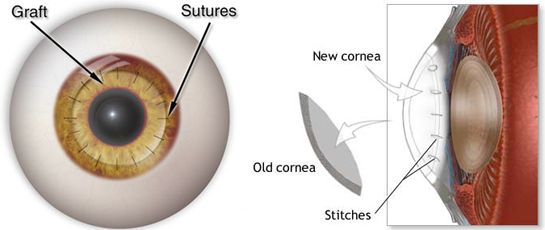 Corneal Surgery